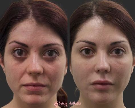 Smile Line Fillers - Before & After Results at Skinly