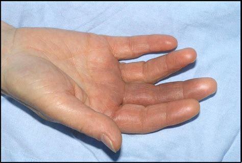 Spontaneous Blue Finger Syndrome: A Benign Process - The American Journal of Medicine