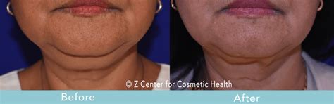 Coolsculpting Double Chin Before & After #3 - Zcosmetic Health