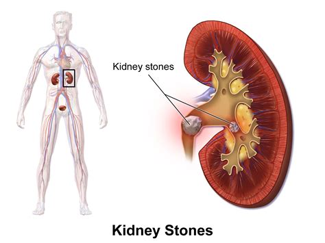 Kidney Stones Symptoms, Causes and Treatment