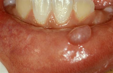 Pictures, Causes, Symptoms & Treatment of Oral Mucocele | HubPages