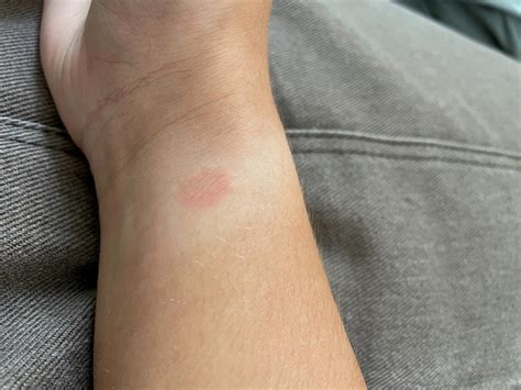 Why Do I Get A Rash After Wearing My Apple Watch ? - DeviceMAG