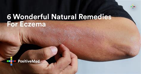 6 Wonderful Natural Remedies For Eczema - PositiveMed