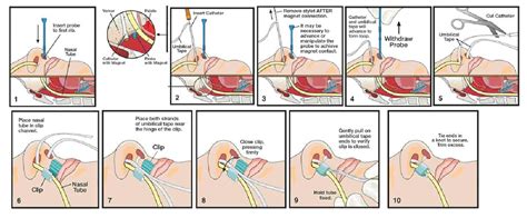 Figure 2 from Nasal Bridle : Married to Your Tube CASE SCENARIOS ...