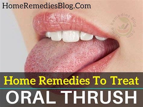 11 Proven Home Remedies To Treat Oral Thrush Naturally | Yeast ...