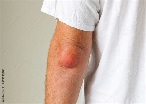 Man swelling erythematous lump pain elbow from Olecranon bursitis, student elbow medical ...