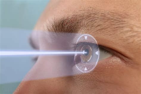 Navigating Laser Eye Surgery Options in the Czech Republic What you need to Know – Whimsy Writes