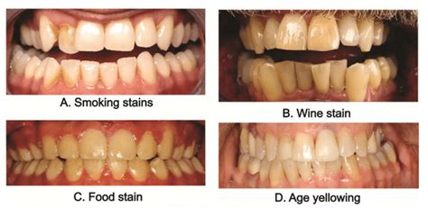 The Science Behind Teeth Whitening | Braddon Dental