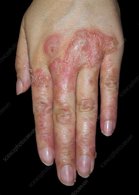 Pemphigus vulgaris - Stock Image - C054/8778 - Science Photo Library