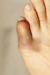 Little Toe Hurts? Four Things to Know About Pinky Toe Pain