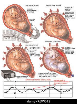 Hypertonic Uterine Contractions Stock Photo: 55067703 - Alamy