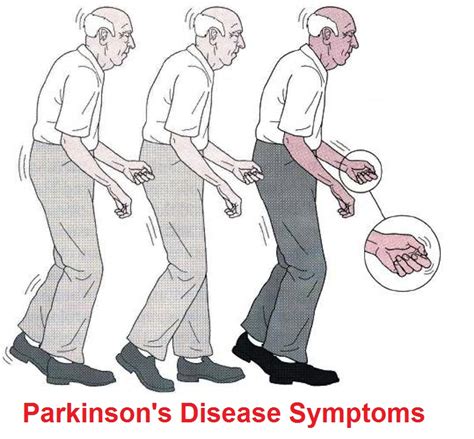 Parkinson's Disease: Signs And Symptoms, Diagnosis, Treatment And ...