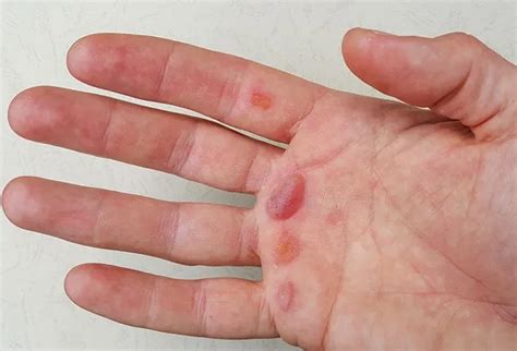 What Are the Causes of Blisters on the Hands? - Okkii.com