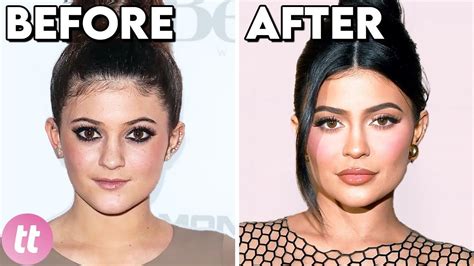 Celebrity Before And After Plastic Surgery