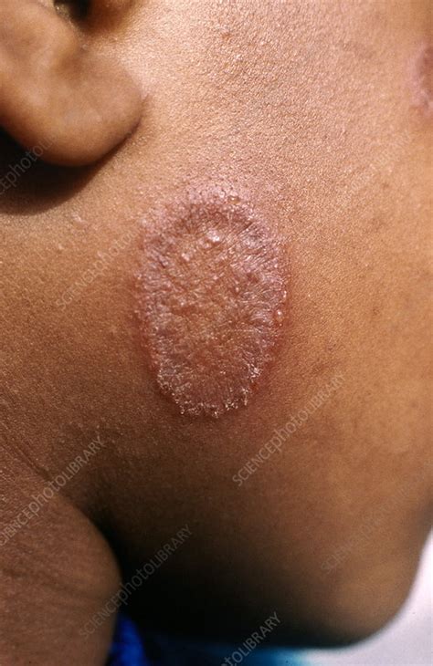 Fungal skin infection - Stock Image - M270/0268 - Science Photo Library