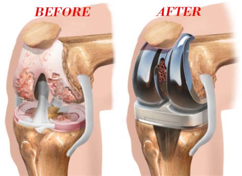 Robotic Knee Replacement Perth, Partial, Full, Information