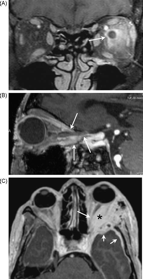 Imaging of the optic nerve - European Journal of Radiology