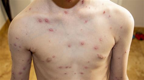 Chickenpox: A Complete Guide to Symptoms, Spread, and More