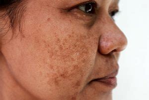 Melasma: Causes, Symptoms And Prevention - Plix