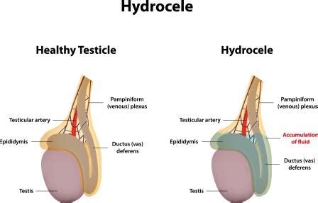 Hydrocele Testis: Modern aspect, Causes, Symptoms, Treatment