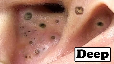 Best Removal Of Deep Big Blackheads In The Ear - YouTube