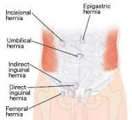 Femoral Hernia - Assignment Point