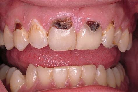 Xerostomia Caries And