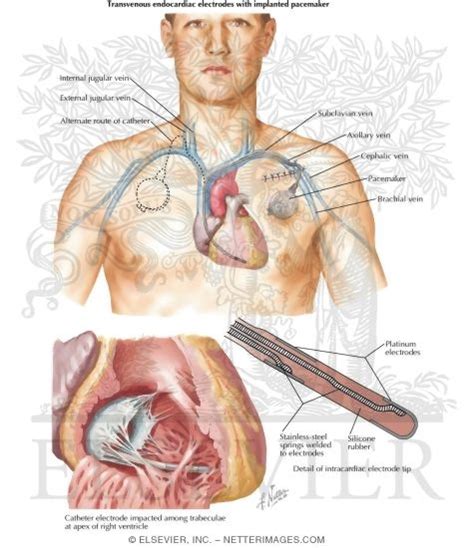 Pacemaker Implantation In Treatment of Complete Heart Block