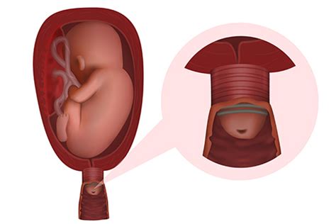 Cerclage | Obstetrics & Gynecology of Atlanta