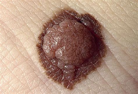 Mole Skin Cancer | Skin Cancer Mole | Mole Skin Cancer | Moles and Skin Cancer | Diseases Pictures