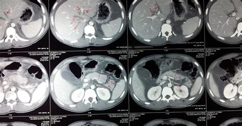 DR. KEYUR S. BHATT (MS, MRCSEd): CASE: distal pancreatectomy with splenectomy post traumatic