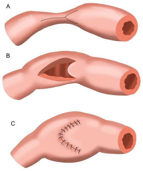 Stricturoplasty - The Operative Review Of Surgery