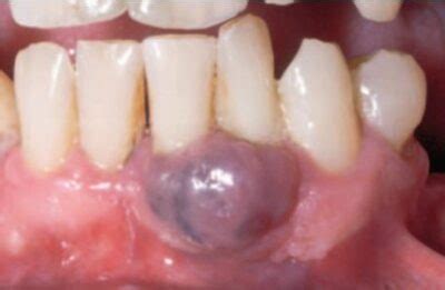 Peripheral Giant Cell Granuloma - Dr. Paul Mirdamadi DDS