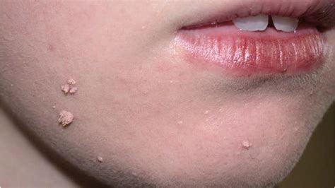 Filiform Wart: Pictures, Symptoms, Causes, Treatments