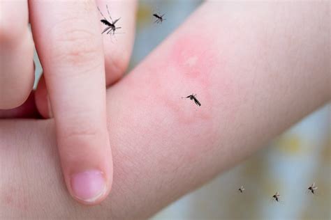 How Bug Bites Can Cause Bruises and How To Prevent Them - MosquitoNix®