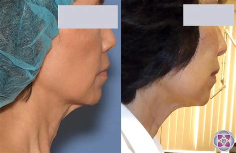 FaceTite & NeckTite Non-Surgical Jowl & Neck Tightening