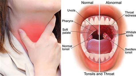 10 Natural remedies for Tonsillitis | MINA Report