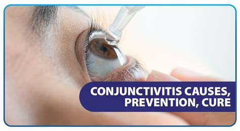 Conjunctivitis: Causes, Prevention, Cure - Unilab