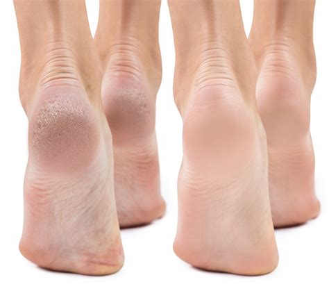 Dry Feet & Cracked Heels: Causes & Treatment - Foot and Ankle Group