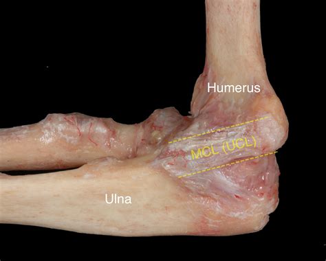 The Tommy John Procedure: How Baseball and Other Throwing Sports May Injure the Elbow,… But Not ...