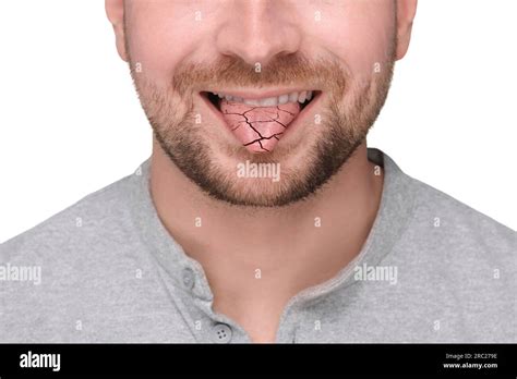 Dry mouth symptom. Man showing dehydrated tongue on white background ...