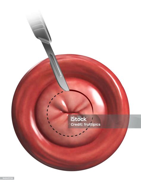 Cone Biopsy Illustration Stock Photo - Download Image Now - Anatomy, Cervix, Cross Section - iStock