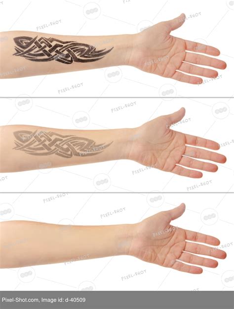 Tattoo on male hand. Laser tattoo removal concept :: Stock Photography ...