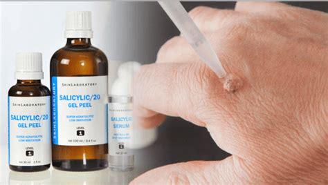 Salicylic Acid For Warts - Hickey Solution