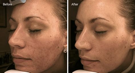 Chemical Peels for Acne Scars: Efficacy, Before and Afters, At-Home Uses