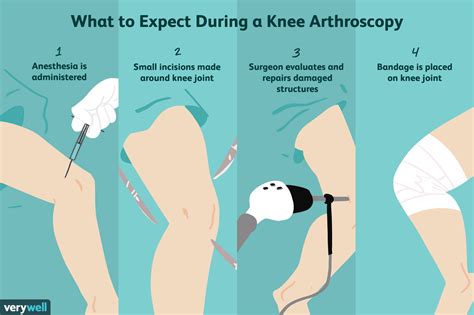 Risks and Complications of Knee Arthroscopy Surgery