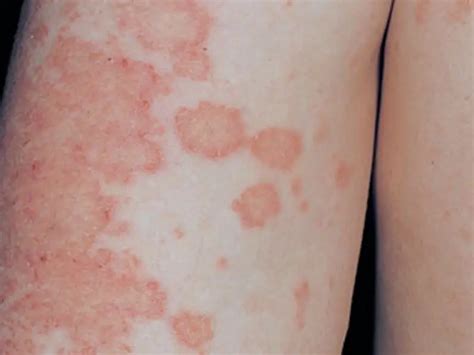 Microbial eczema: causes, symptoms, diagnosis and treatment features | Health 2024