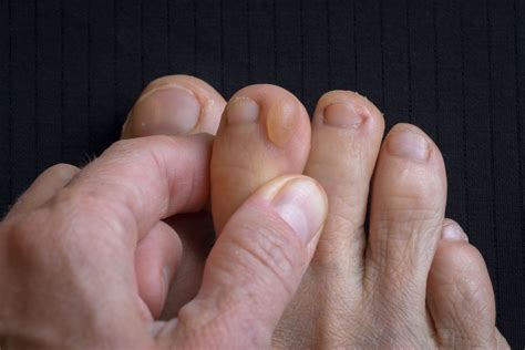 Blood Blister On Foot Should I Pop It Discount | emergencydentistry.com