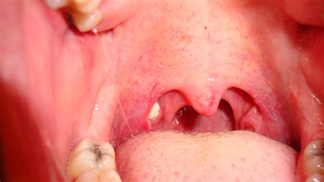 I Have Tonsil Stones and Bad Breath | Windsor Dentists