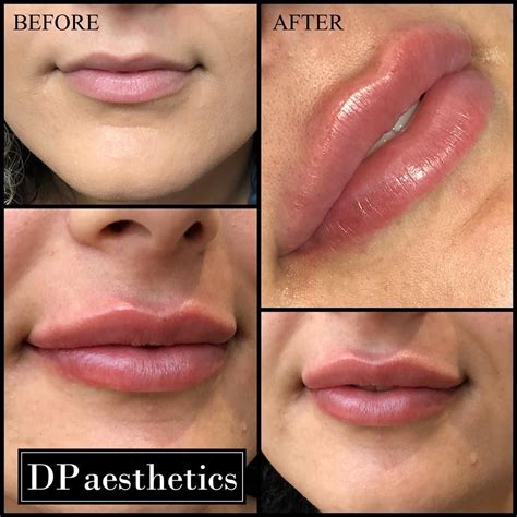 Pin by Jenny Phongsavath on ♡︎filler me up in 2021 | Lip augmentation ...